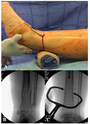 Tibial Intramedullary Nail Fixation Technique-6 Tècnica de fixació de l'ungla intramedul·lar tibial-6