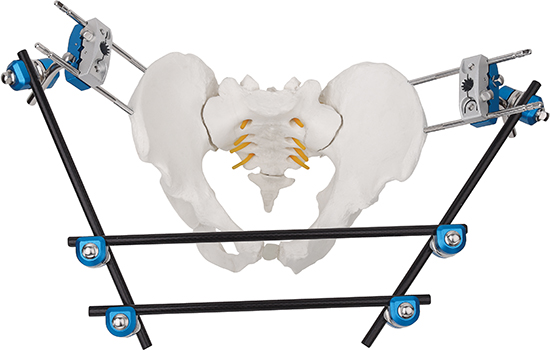 Surgeries Using External Fixators ꯃꯄꯥꯅꯒꯤ ꯐꯤꯛꯁꯇꯔꯁꯤꯡ ꯁꯤꯖꯤꯟꯅꯗꯨꯅꯥ ꯁꯔꯖꯔꯤꯁꯤꯡ꯫