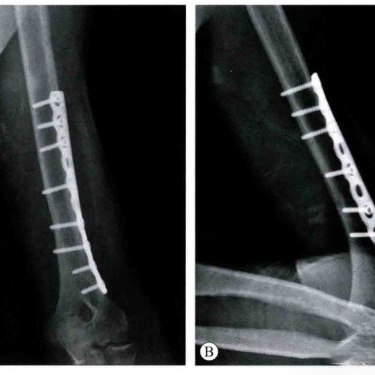 How Orthopaedic Implants Work ኦርቶፔዲክ መትከል እንዴት እንደሚሰራ