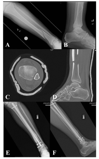 Tibial Intramedullary Nail Fixation Technique-2 Tècnica de fixació de l'ungla intramedul·lar tibial-2