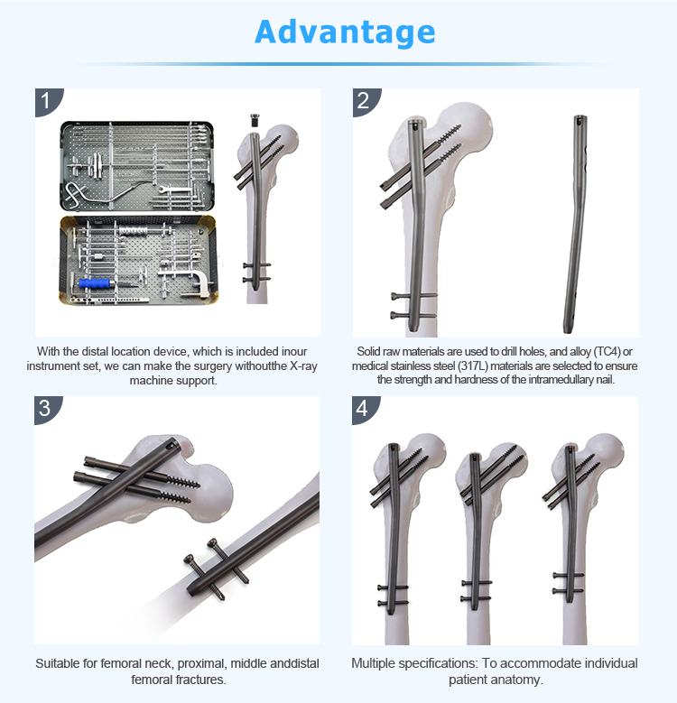 Titanium Gamma Nail | Proximal Femoral Fracture Fixation Implants - XC Medico - 3 ꯇꯥꯏꯇꯅꯤꯌꯝ ꯒꯥꯃꯥ ꯅꯦꯜ | ꯄ꯭ꯔꯣꯛꯁꯤꯃꯥꯜ ꯐꯦꯃꯣꯔꯦꯜ ꯐ꯭ꯔꯦꯀꯆꯔ ꯐꯤꯛꯁꯦꯁꯟ ꯏꯃꯞꯂꯥꯟꯇꯁꯤꯡ - ꯑꯦꯛꯁ.ꯁꯤ.ꯃꯦꯗꯤꯀꯣ - ꯳
