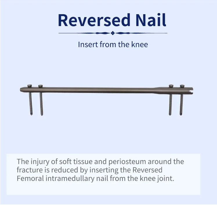 Kusinthidwa kwa Femoral Intramedullary Nail-2