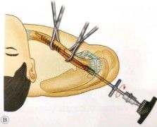 Διάγνωση και θεραπεία κατάγματος κλείδας-20