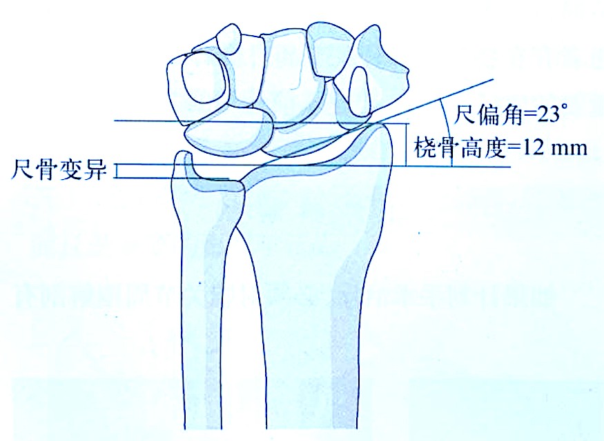 Zlomi distalnega radiusa-1