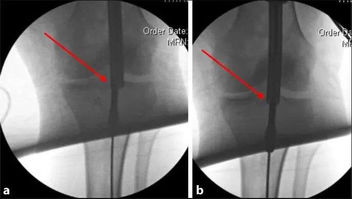 fractures tibial, suprapatellar intramedullary t&eacute;hnik kuku-23