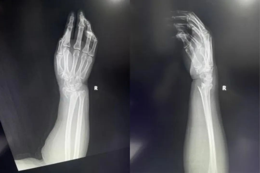 Zlomi distalnega radiusa-19