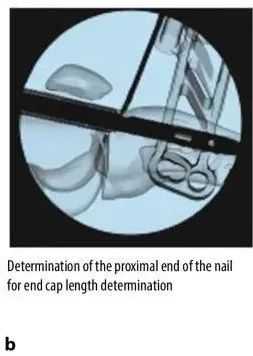 fractures tibial, suprapatellar intramedullary t&eacute;hnik kuku-19