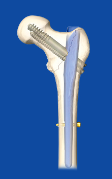 Intramedulláris köröm