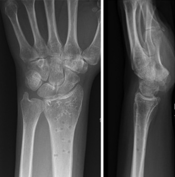 Zlomi distalnega radiusa-14