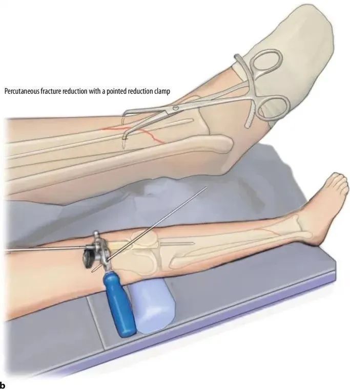 fraktur tibial, suprapatellar intramedullary t&eacute;hnik kuku-15