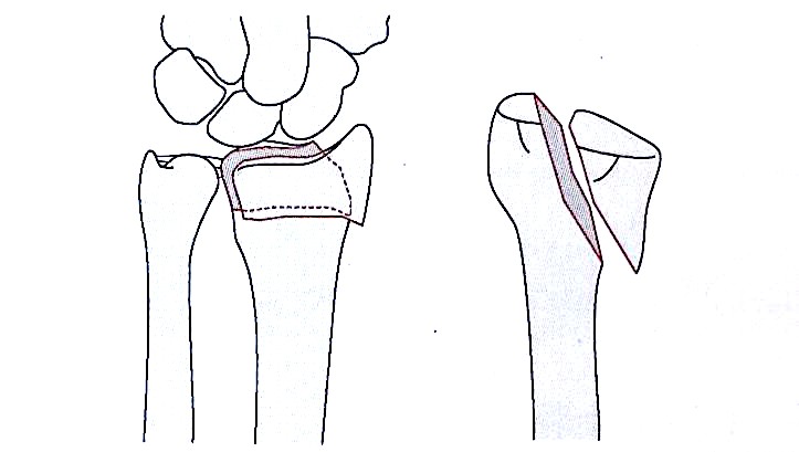 Zlomi distalnega radiusa-4
