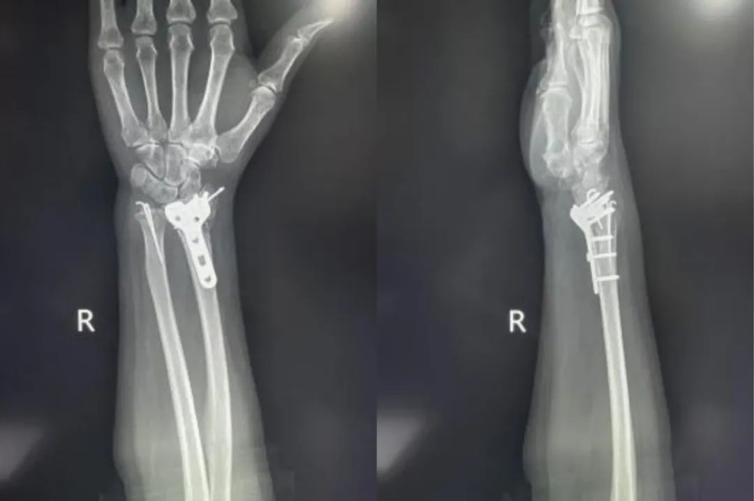 Zlomi distalnega radiusa-20