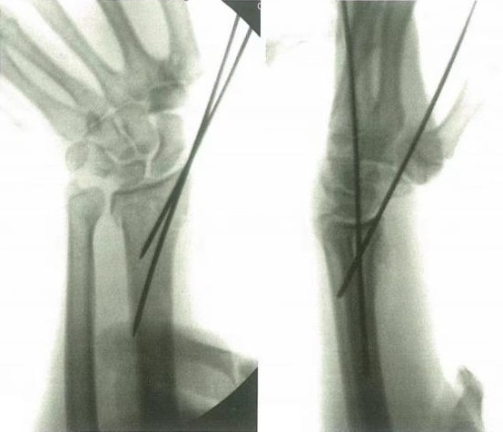 Zlomi distalnega radiusa-9