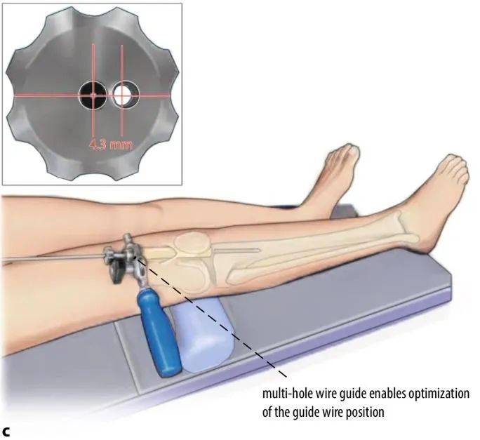 fraktur tibial, suprapatellar intramedullary t&eacute;hnik kuku-9