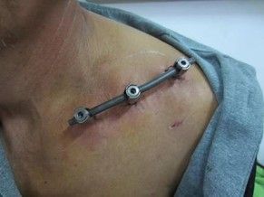 Διάγνωση και θεραπεία του κάταγμα της κλείδας-29