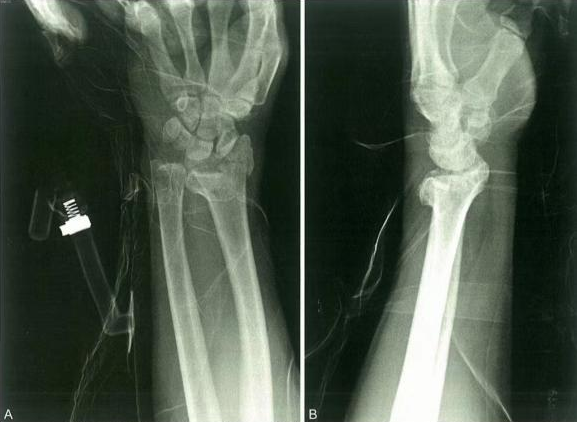 Zlomi distalnega radiusa-22