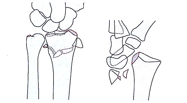 Zlomi distalnega radiusa-6