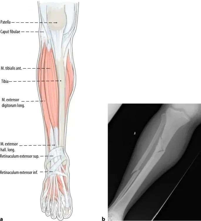 Fraktur tibial, t&eacute;hnik kuku intramedullary suprapatellar-2