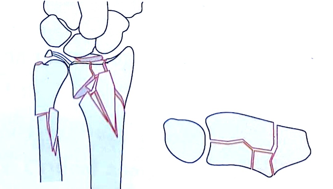 Zlomi distalnega radiusa-7