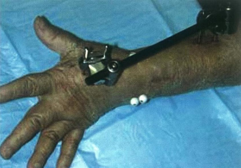 Zlomi distalnega radiusa-10