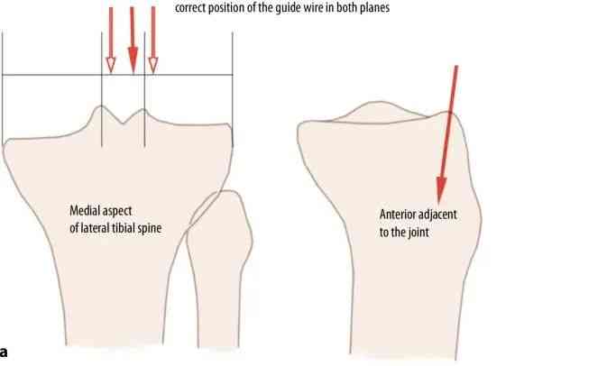 fraktur tibial, suprapatellar intramedullary t&eacute;hnik kuku-10
