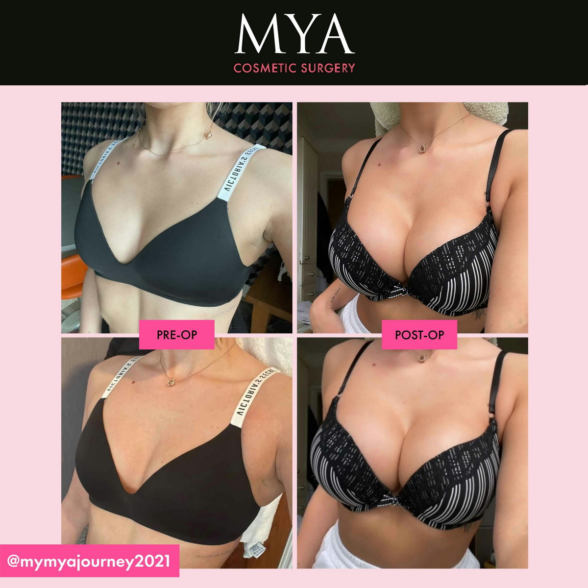 Quando possum gere A Certamen bikini post pectus Augmentation?