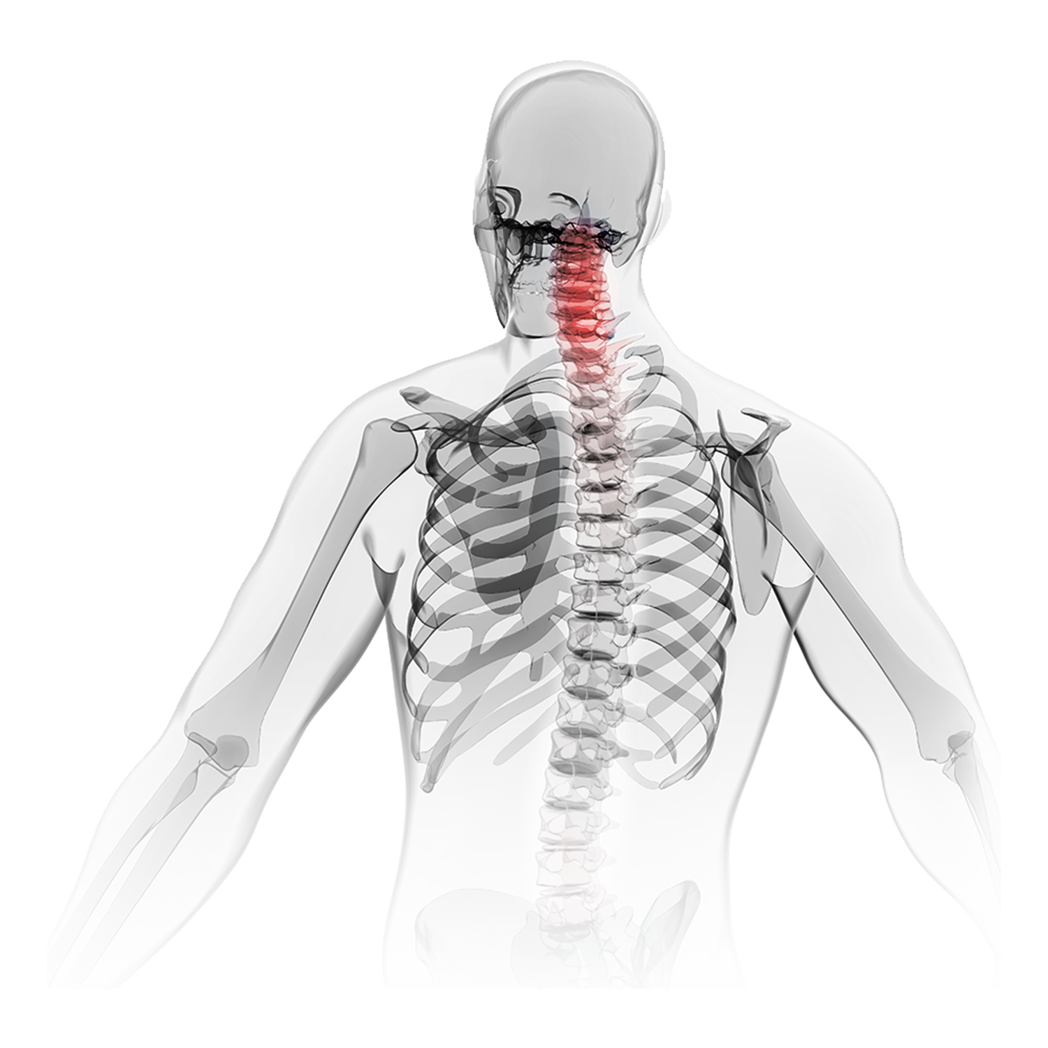 ACDF &ntilde;awpaqninpi columna cervical columna vertebral quir&uacute;rgica soluci&oacute;n