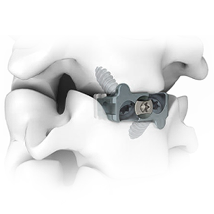 Jaula cervical cero-perfil kaqwan tornillo fijaci&oacute;n integrada kaqwan