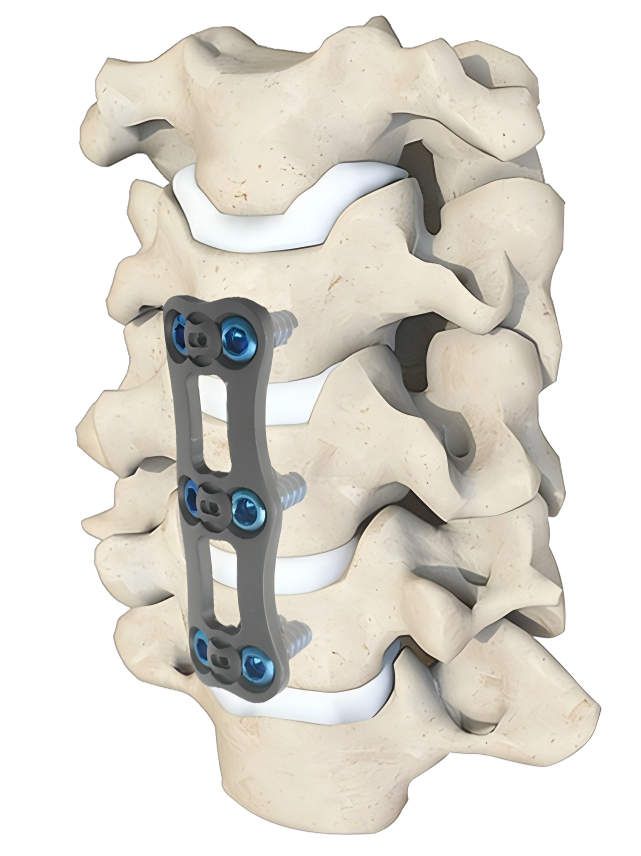 Placa cervical anterior nisqa columna cervical nisqapi fijaci&oacute;n