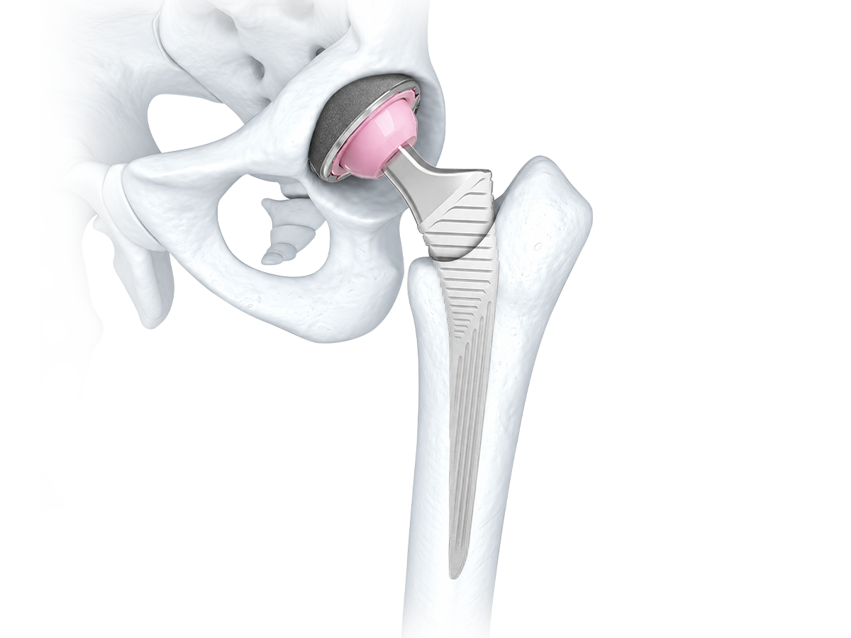 Primary Total Hip Replacement System