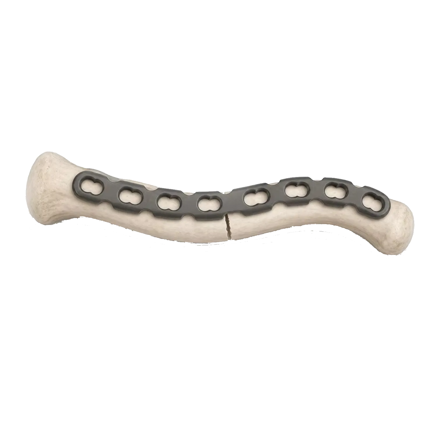 S-Klavikle Sperrplack fix&eacute;iert op engem Clavicle Knochenmodell iwwer e Midshaft Fraktur